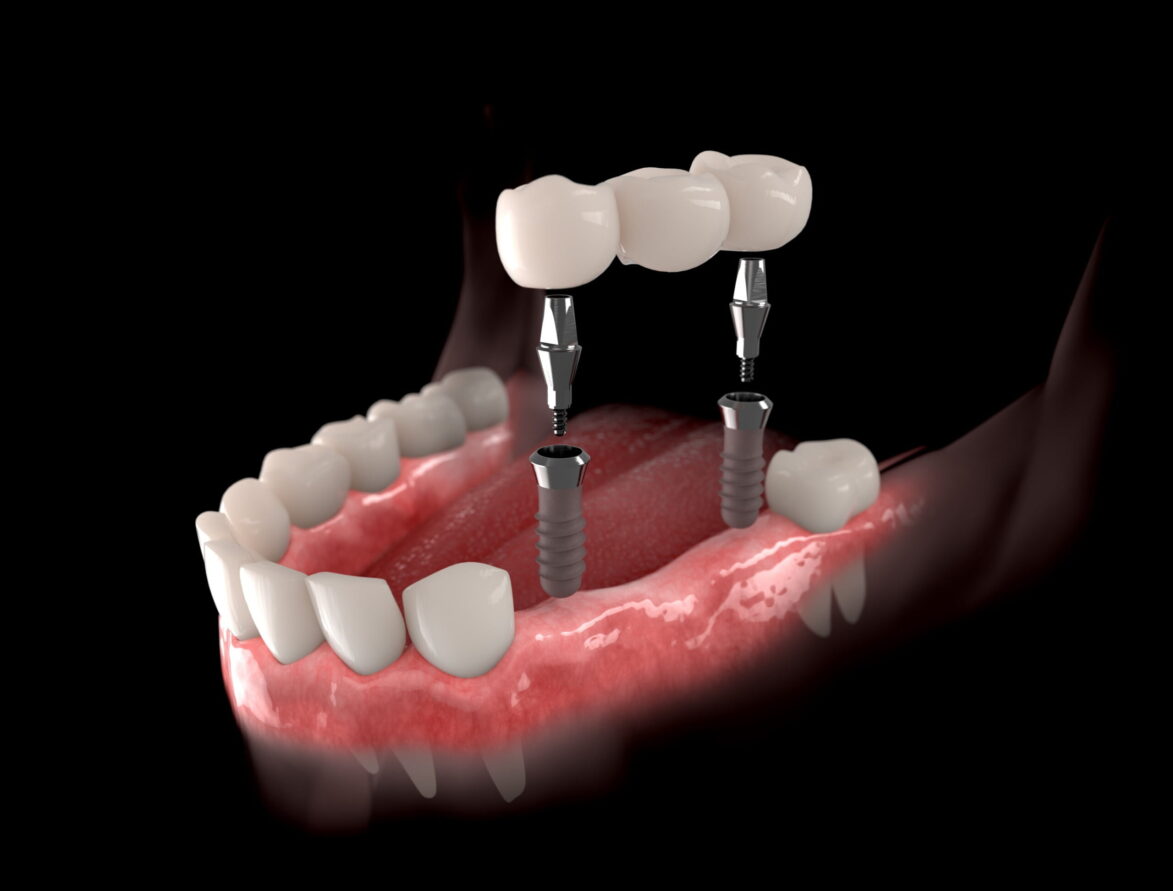 bridging the gaps thumb