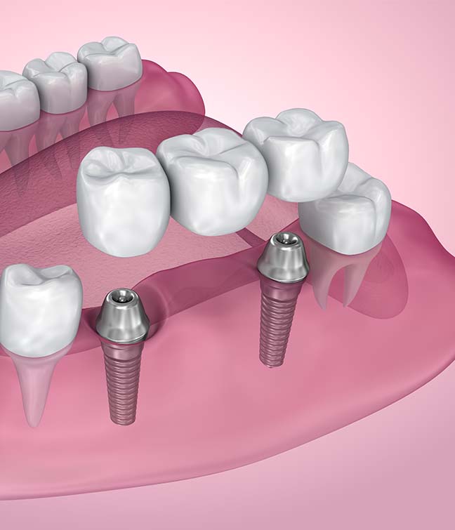 Treatment - Paddock Dental