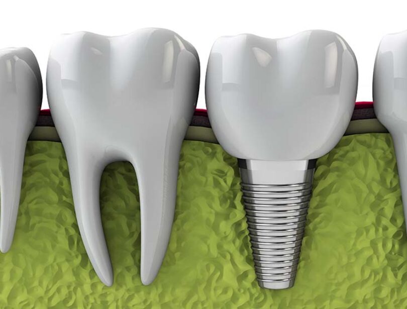 Blog - Paddock Dental